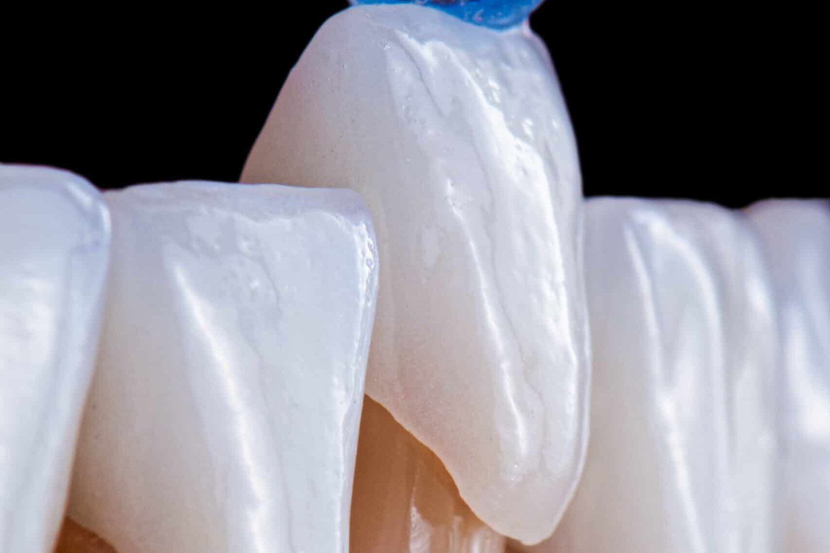 dental job photography, crowns veneers implants